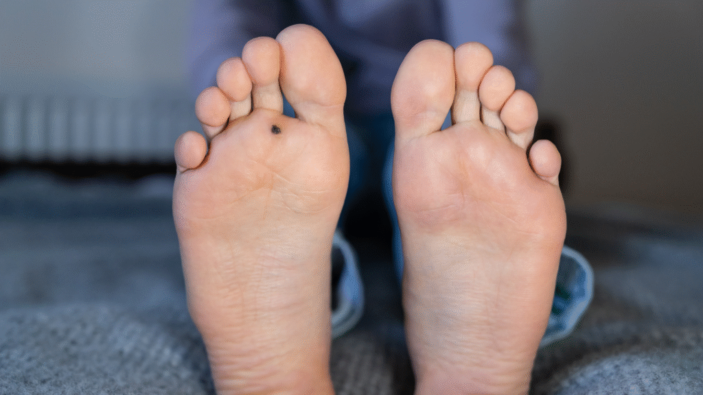 Papilomas plantares: qué son, cómo identificarlos y cuál es su tratamiento 3 Papilomas plantares