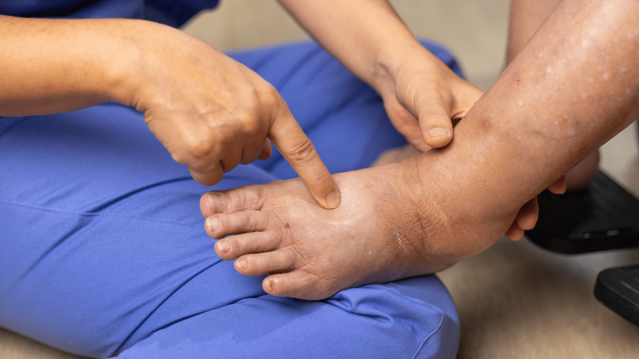Piernas cansadas e hinchadas en verano: cuándo es circulación y cuándo es traumatológico 1 piernas hinchadas verano